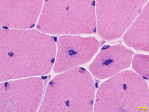 図3．中心核ミオパチー。筋線維の核は正常では、筋線維の辺縁部に存在する。中心核ミオパチーでは、中心部に核が存在する筋線維が多く認められる。